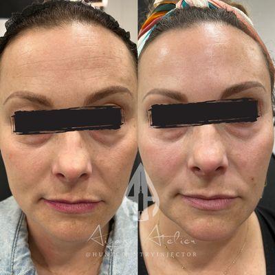 Chemical peel and tox