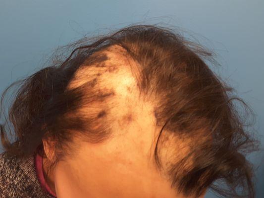 Pre 1st PRP treatment Alopecia Areata