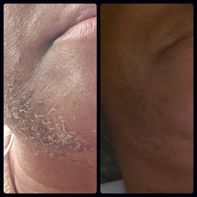 9 months of treatments