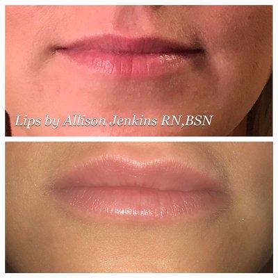 Before/after filler in the lips