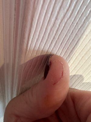 Cut and pain from cutting and filing skin on thumb