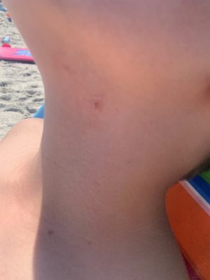 Bed bug bites on my son.