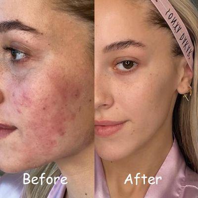 Acne cleared after facial treatments