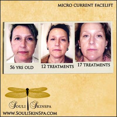 microcurrent therapy for erasing fine lines and wrinkles