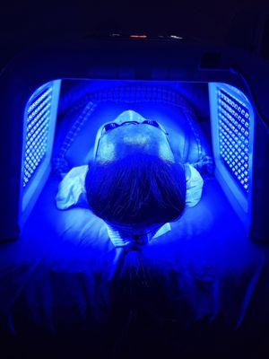 LED Light Therapy for Acne