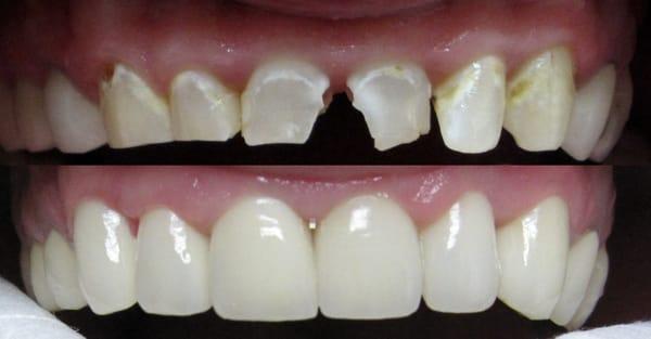 Complete smile makeovers to restore confidence and preserve a healthy smile