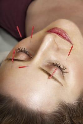 acupuncture therapy