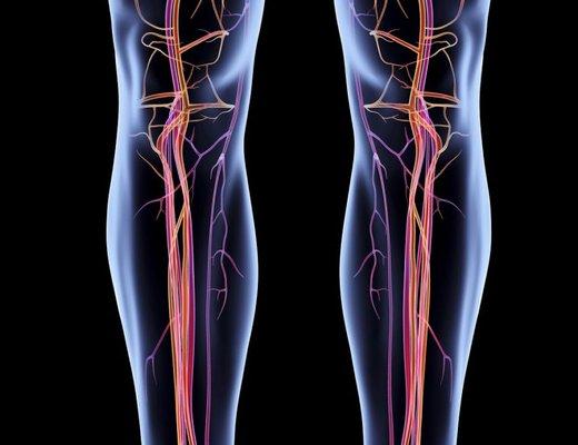 PAD - Peripheral Arterial Disease, Procedure performed in-office...call us today for free consult!