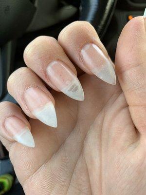 Nail bed irritation and misshaped 'stiletto' nails.