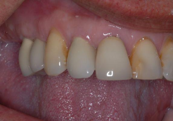 replacement of 3 missing upper teeth with dental implants