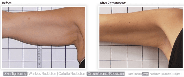 Cellulite reduction. Non surgical lipo reduction.  Fat burning. Restorative treatments.