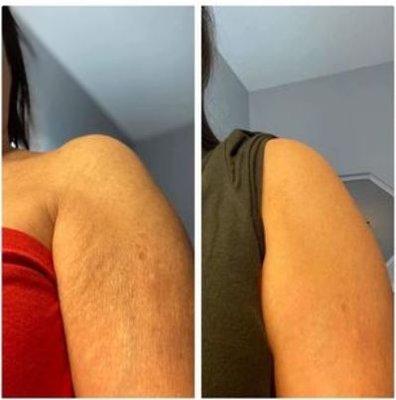 Arm Cellulite