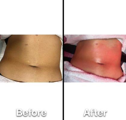 Cool sculpting treatment before and after one session treatment