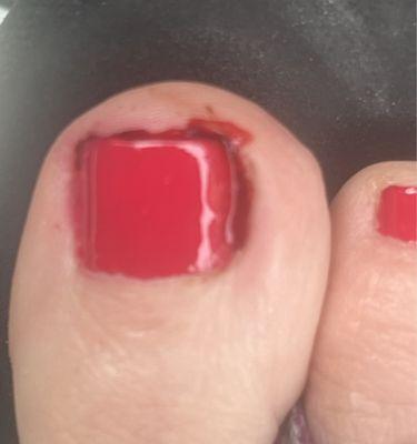 Pedicure gone wrong!!