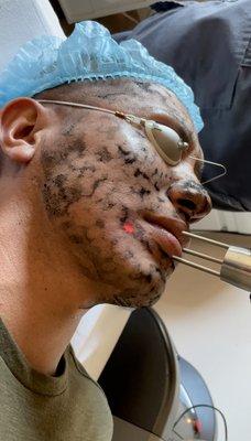 Carbon Laser Facial