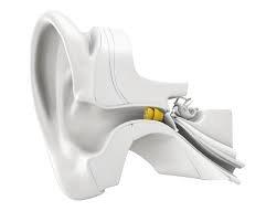 Lyric Hearing Device