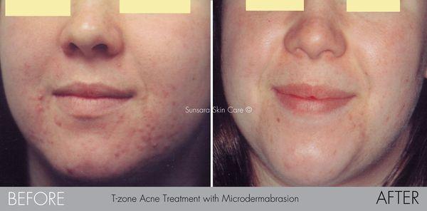 Acne Treatment