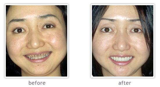 We change the appearance of stained teeth with the latest techniques in cosmetic dentistry.