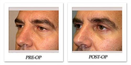 Blepharoplasty (Eyelid Surgery)