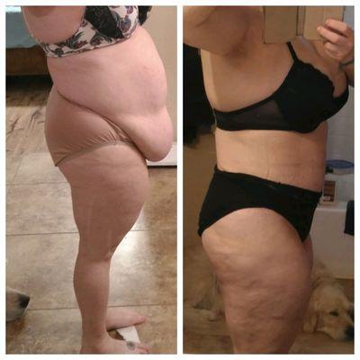 Before and after tummy tuck by Dr Bass.