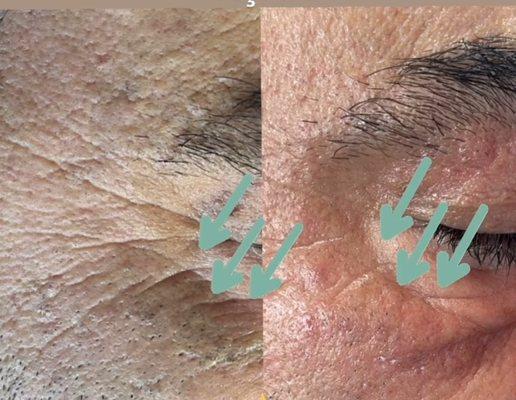 skin care blackhead removal