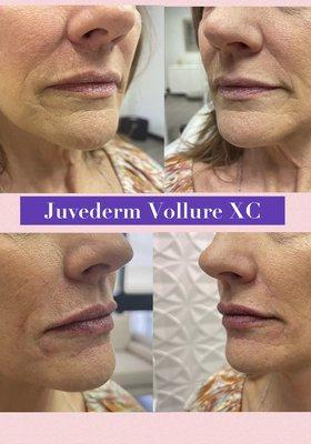 Lip enhancements with Hialuronic Acid