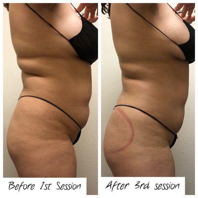 Before & After: 3 sessions of ultrasonic cavitation, radio frequency skin tightening & wood therapy and 3 vacuum butt enhancement sessions