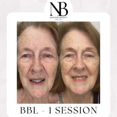 After just 1 BBL treatment, these are the results. The most powerful and effective IPL on the market!