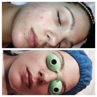 Acne before and after