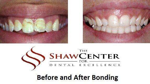 Have your Cosmetic Bonding Change your Smile for the Better!