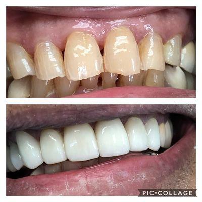 Porcelain veneers and porcelain crowns