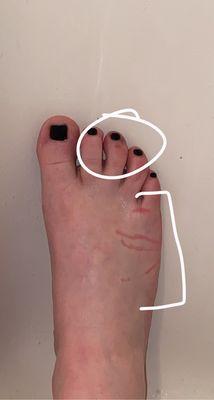 Painted Toenails/ burn marks on skin.