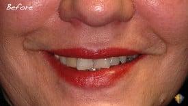 Before Veneers