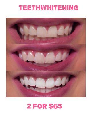 Achieve up to 8 shades lighter with Our FDA Approved Teethwhitening Treatment.