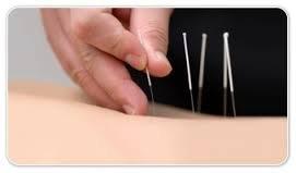 Acupuncture 40.00 Sessions