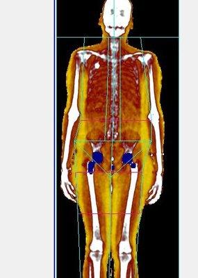 DEXA Scanning can Help Identify Exactly Where Body Fat Lies and how Risky it May Be.