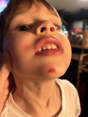 Daycare injuries