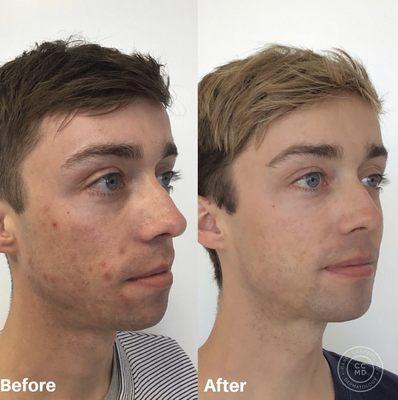 Before and after, just a few months into my acne treatments with Dr. Campbell