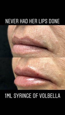 Lip enhancement