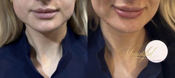 Before and after lip filler