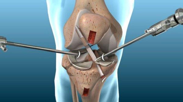 ACL Surgery