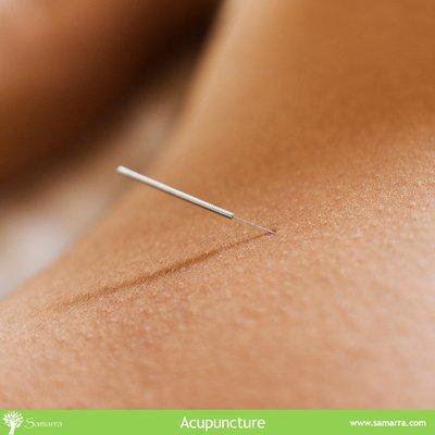 Acupuncture