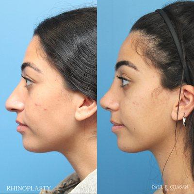 Rhinoplasty by Dr. Paul Chasan