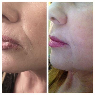 Injectable filler can improve lip and nasolabial fold lines