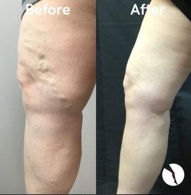 Before and after of the combination of treatments of Spider Veins and Varicose Veins