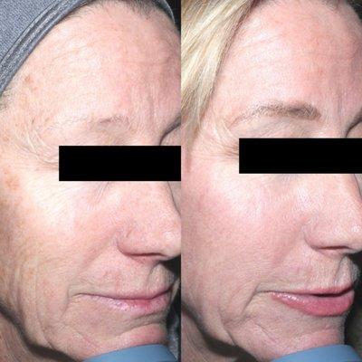 Halo Laser Treatment