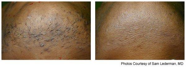 Hair Removal for all skin types. Safe and Effective