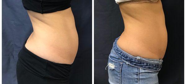 Results after one session from a SculpSure patient - results will continue to appear!