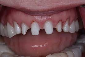 this is what my teeth looked like after I left this awful dentist.