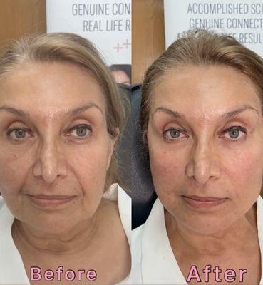 PDO Facelift before and After